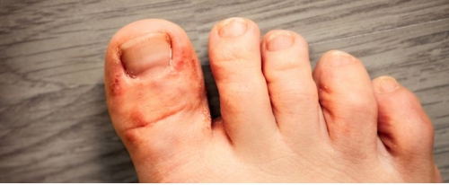 How to Relieve Foot Fungus