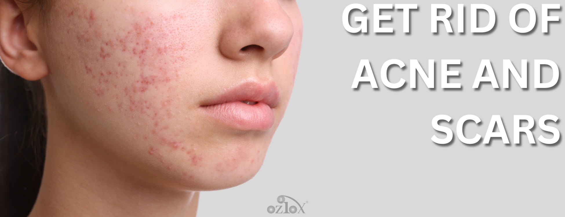 Get rid of acne and scars